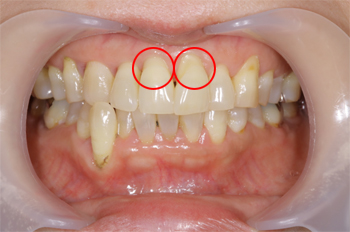 歯周病治療 神戸の歯医者 三宮アップル歯科