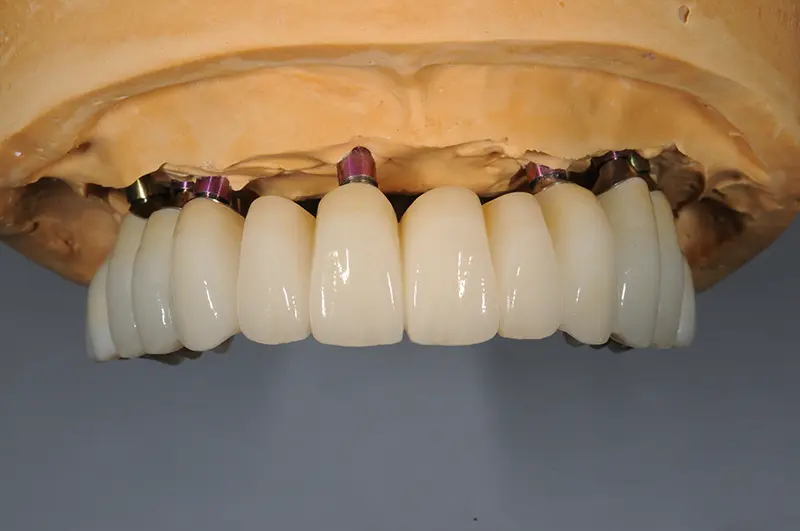 フルマウス治療の模型