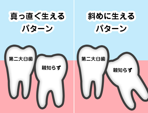 親知らずは痛くなければ歯医者にいかなくても良い 神戸の歯医者 三宮アップル歯科