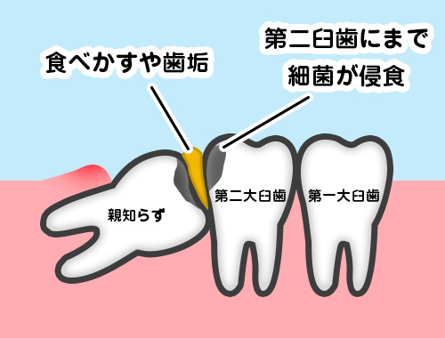 舞踏病とは何ですか?