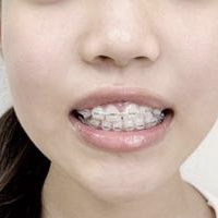 矯正装置が目立つ、ワイヤー矯正のイメージ